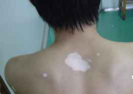 白斑病病治疗的期间或许有多长