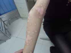 白癜风要怎么治才会治好