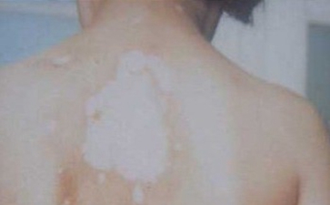 白癜风患者的治疗注意事项有哪些 白癜风患者的治疗注意事项有哪些